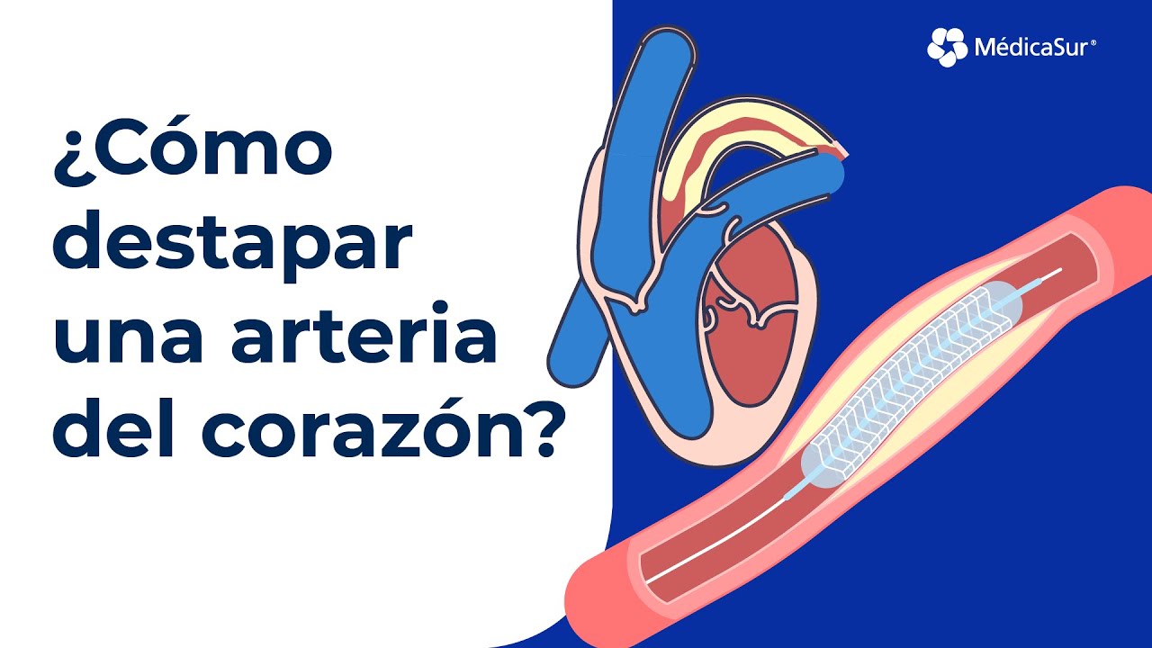 Estrategias para Eliminar Obstrucciones en Pontevedra